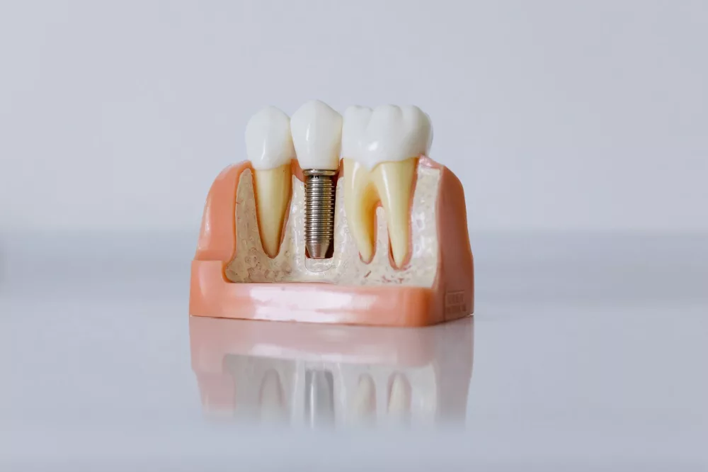 Making Dental Implants Accessible: Unpacking Affordable Options